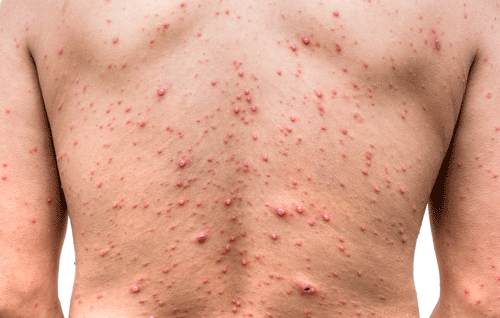 Viral Disease - Skin Rashes For A Person.