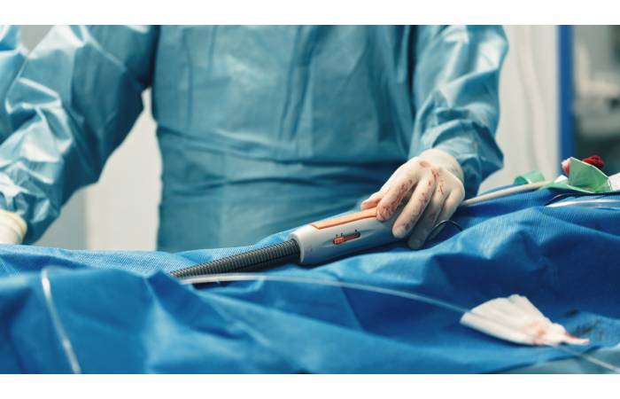 Close up image of an interventional cardiologist using wire catheter delivery system on a patient lying on the OT table for stent graft procedure.